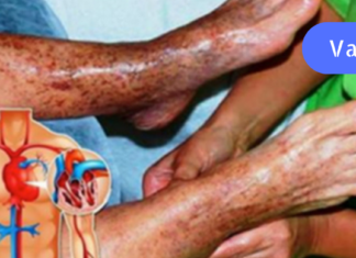 ფანტასტიკური რეცეპტი, რომელიც ხსნის თრომბებს: ეს ნამდვილი ხსნაა ვარიკოზული ვენებით დაავადებული ადამიანებისთვის!