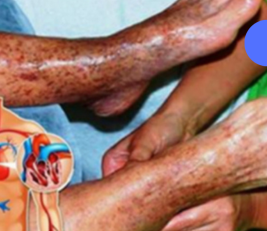 ფანტასტიკური რეცეპტი, რომელიც ხსნის თრომბებს: ეს ნამდვილი ხსნაა ვარიკოზული ვენებით დაავადებული ადამიანებისთვის!