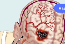 როგორ გავაუმჯობესოთ ცერებრალური მიმოქცევა ხალხური საშუალებების დახმარებით?