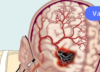 როგორ გავაუმჯობესოთ ცერებრალური მიმოქცევა ხალხური საშუალებების დახმარებით?