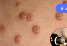 წაისვით ეს ნიღაბი მეჭეჭებზე და ისინი მალე გაქრება!