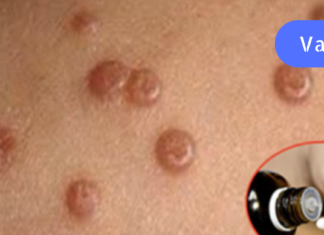 წაისვით ეს ნიღაბი მეჭეჭებზე და ისინი მალე გაქრება!