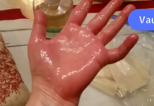 უკეთესია ვიდრე ტკივილგამაყუჩებლები: წაისვით ეს ზეთი ტკივილის მყისიერი შემსუბუქებისთვის! ართრიტის, რადიკულიტის ან ზურგის ტკივილის მქონე ადამიანებისთვის ეს საუკეთესო მეთოდია!