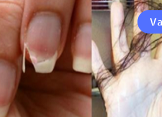 თუ თმა გამუდმებით გცვივათ და ფრჩხილები მტვრევადი გაქვთ, მაშინ მიირთვით ეს საკვები და ყველაფერი მალევე მოგვარდება!