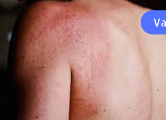 დიაბეტის 8 გამაფრთხილებელი ნიშანი, რომელიც შეიძლება გამოვლინდეს თქვენს კანზე!