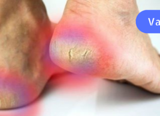 როგორ დავარბილოთ დაბზარული ქუსლები ბუნებრივად ამ საშუალებების გამოყენებით!