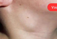 15 ნიშანი იმისა, რომ თქვენი ლიმფა გადატვირთულია! როგორ დავეხმაროთ მის გადინებას?!