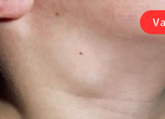 15 ნიშანი იმისა, რომ თქვენი ლიმფა გადატვირთულია! როგორ დავეხმაროთ მის გადინებას?!