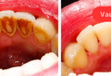 2 დღეში მოიშორებთ კბილის ქვას! წარმოუდგენელი შედეგი, რომელსაც ამ საშუალების გამოყენებისას შეამჩნევთ