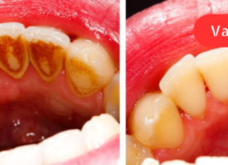 2 დღეში მოიშორებთ კბილის ქვას! წარმოუდგენელი შედეგი, რომელსაც ამ საშუალების გამოყენებისას შეამჩნევთ