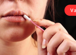 ჰერპესთან ბრძოლის ბუნებრივი გზები!