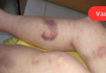 სისხლის ცუდი მიმოქცევა გაქვთ? ნახეთ, როგორ შეგიძლიათ მოაგვაროთ ეს პრობლემა!