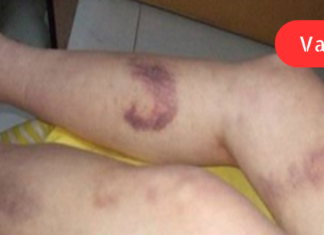 სისხლის ცუდი მიმოქცევა გაქვთ? ნახეთ, როგორ შეგიძლიათ მოაგვაროთ ეს პრობლემა!