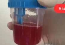 რატომ ჩნდება სისხლში შარდი? ხალხური ტრადიციული რეცეპტები მკურნალობისთვის