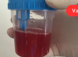 რატომ ჩნდება სისხლში შარდი? ხალხური ტრადიციული რეცეპტები მკურნალობისთვის