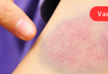 9 ადრეული გაფრთხილება იმისა, რომ თქვენს ორგანიზმში C ვიტამინის ნაკლებობაა