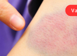 9 ადრეული გაფრთხილება იმისა, რომ თქვენს ორგანიზმში C ვიტამინის ნაკლებობაა