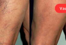 წამალი, რომელიც ათავისუფლებს ვარიკოზულ ვენებს – მხოლოდ 1 პროდუქტია საჭირო და 15 წუთი