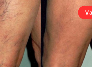 წამალი, რომელიც ათავისუფლებს ვარიკოზულ ვენებს – მხოლოდ 1 პროდუქტია საჭირო და 15 წუთი