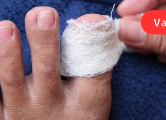 აი, როგორ შეგიძლიათ მოიცილოთ ჩაზრდილი ფრჩხილების პრობლემა ამ 5 საშინაო საშუალებით