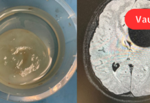 ექინოკოკოზი ადამიანისა და ცხოველის პარაზიტული დაავადებაა.სწორედ ჩვენი სტატია მოგვითხრობს ექინოკოკოზის სიმპტომებისა და მკურნალობის შესახებ!