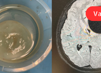 ექინოკოკოზი ადამიანისა და ცხოველის პარაზიტული დაავადებაა.სწორედ  ჩვენი სტატია მოგვითხრობს ექინოკოკოზის სიმპტომებისა და მკურნალობის შესახებ!