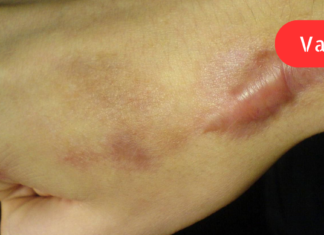 როგორ ვუმკურნალოთ ჭრილობებს ისე, რომ შემდგომ ნაწიბურები არ დაგვრჩეს კანზე! ბებიის უკვდავი მეთოდები