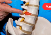 მხოლოდ ამ 3 ინგრედიენტის გამოყენებით მოიშორეთ მალთაშუა დისკის თიაქარი!