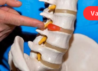 მხოლოდ ამ 3 ინგრედიენტის გამოყენებით მოიშორეთ მალთაშუა დისკის თიაქარი!