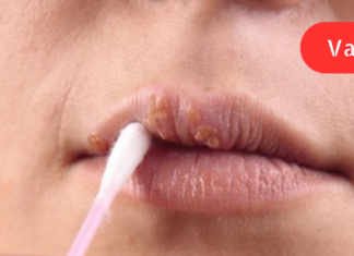 ტუჩზე გამონაყარი თითქმის ყოველი გაციების შემდეგ მიჩნდება. როგორც ექიმმა მითხრა, ამას მარტივი ჰერპესი ჰქვია. გამონაყართან ბრძოლის ყველაზე საიმედო და სწრაფი მეთოდი კი . .