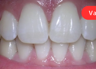 სახლის პირობებში სულ რაღაც 5 ლარად გავიმაგრე ღრძილები! ყველას გირჩევდით ამ მეთოდის გამოყენებას. .