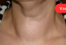 ვისაც ფარისებრი ჯირკვლის დაავადება — ჩიყვი აწუხებს, წამლად გამოადგება თეთრი ხახვი, რომელიც აპატარავებს ჩიყვს! გამოყენებისთანავე ამ საშუალების მადლიერნი დარჩებით