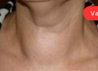 ვისაც ფარისებრი ჯირკვლის დაავადება — ჩიყვი აწუხებს, წამლად გამოადგება თეთრი ხახვი, რომელიც აპატარავებს ჩიყვს! გამოყენებისთანავე ამ საშუალების მადლიერნი დარჩებით