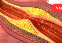 70-ს უკვე გადავცილდი, მაგრამ სულაც არ ვაპირებ დავმორჩილდე ბედს! წამლები არ მიყვარს, მაგრამ ძალიან ვაფასებ ხალხურ რეცეპტებს და სწორედ დედაჩემის ჩანაწერებში ვიპოვე ათეროსკლეროზის სამკურნალო რეცეპტი: