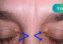 გაიგეთ რისი მანიშნებელია ქუთუთოზე გამოსული ეს გამონაზარდები!! ყურადღებით იყავით და არ გამოგრჩეთ ეს გაფრთხილება . .