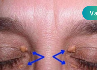 გაიგეთ რისი მანიშნებელია ქუთუთოზე გამოსული ეს გამონაზარდები!! ყურადღებით იყავით და არ გამოგრჩეთ ეს გაფრთხილება . .