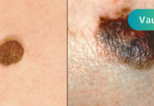 საშუალება, რომლის დახმარებითაც პრობლემად ქცეული ხალი სრულად გავიქრე!