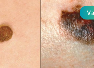 საშუალება, რომლის დახმარებითაც პრობლემად ქცეული ხალი სრულად გავიქრე!