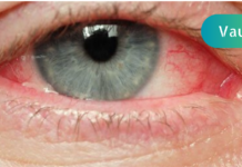 ხშირად გქონიათ მსგავსად გაღიზიანებული თვალი?! და თუ პასუხი დადებითია, გიზიარებთ მისი მკურნალობა ბუნებრივ საშუალებებს. .