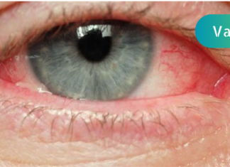 ხშირად გქონიათ მსგავსად გაღიზიანებული თვალი?! და თუ პასუხი დადებითია, გიზიარებთ მისი მკურნალობა ბუნებრივ საშუალებებს. .