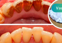 ეს საშუალება ძალიან გაყვითლებულ კბილებსაც გაათეთრებს და კბილის ქვას მოგაშორებთ. შესანიშნავი ეფექტი აქვს!!