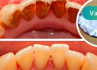 ეს საშუალება ძალიან გაყვითლებულ კბილებსაც გაათეთრებს და კბილის ქვას მოგაშორებთ. შესანიშნავი ეფექტი აქვს!!