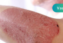 წლებია ვემადლიერები რეცეპტს, რომელმაც ჩემი შვილი ფსორიაზისგან იხსნა!! იქნებ თქვენც გამოგადგეთ, ნახეთ აბა