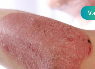 წლებია ვემადლიერები რეცეპტს, რომელმაც ჩემი შვილი ფსორიაზისგან იხსნა!! იქნებ თქვენც გამოგადგეთ, ნახეთ აბა