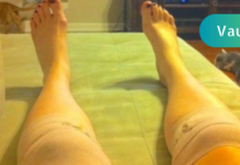 გთავაზობთ მუხლის კომპრესს, რომელიც მთელი ღამე უნდა გაიჩეროთ და დილით უკვე ყველანაირი დისკომფორტი მოშორებული გექნებათ!