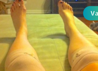 გთავაზობთ მუხლის კომპრესს, რომელიც მთელი ღამე უნდა გაიჩეროთ და დილით უკვე ყველანაირი დისკომფორტი მოშორებული გექნებათ!