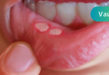 სტომატიტი ერთ ღამეშიც შეგიძლიათ მოირჩინოთ! ესაა საკმაოდ მარტივი და ეფექტური მეთოდი!!