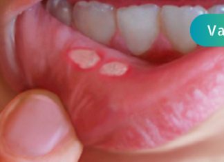 სტომატიტი ერთ ღამეშიც შეგიძლიათ მოირჩინოთ! ესაა საკმაოდ მარტივი და ეფექტური მეთოდი!!