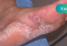 როგორ შეიძლება გაგიჩნდეთ ფეხის სოკო და როგორ ვუმკურნალოთ