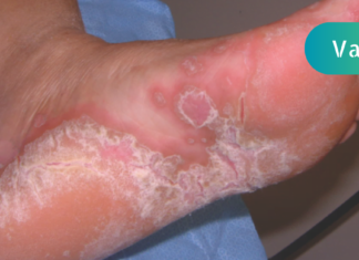 როგორ შეიძლება გაგიჩნდეთ ფეხის სოკო და როგორ ვუმკურნალოთ